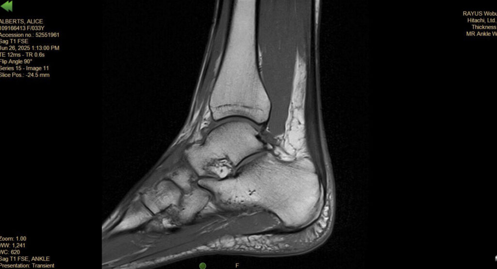 MRI of the left Achilles tendon in professional IRONMAN triathlete Alice Alberts demonstrating findings consistent with chronic Achilles tendinopathy prior to rehabilitation at Mui Chiropractic & Sports Medicine.
