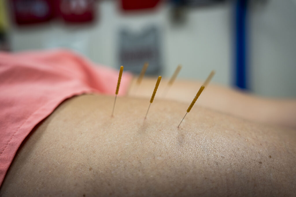 Dry Needling in Newton MA | Mui Chiropractic & Sports Medicine