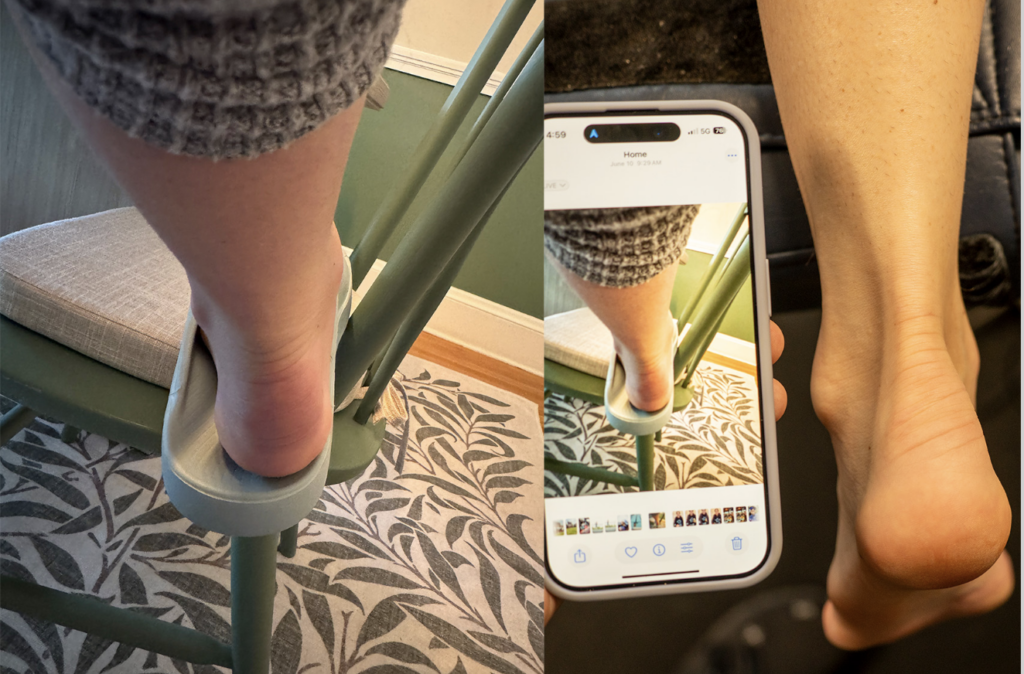 Before-and-after image: Alice Alberts’ left Achilles before and after Achilles tendinopathy treatment